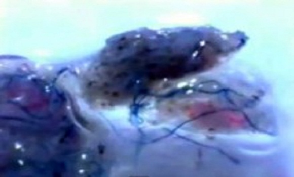 Video Thousands Now Infected With Nano Worms In The USA