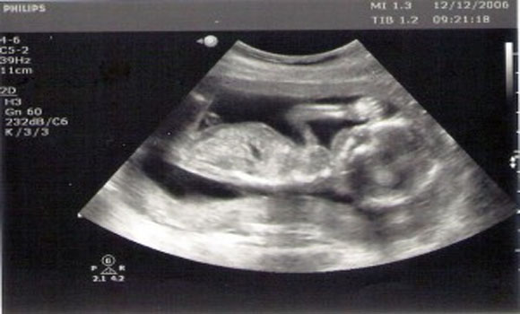 Ultrasound – One of The Worst Things You Can Do To a Developing Fetus