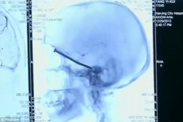 He Went in to the Hospital Because he Was Feeling Sick, What They Found in His Head Might Make YOU Sick