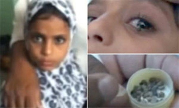 Girl leaves doctors baffled as she cries stones rather than tears