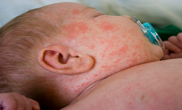 90 of Those Infected with Measles in New York Outbreak Are Vaccinated