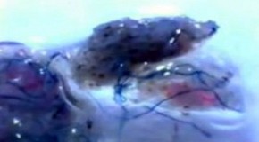 Video: Thousands Now Infected With Nano Worms In The USA