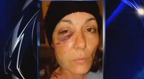 Illinois woman has reconstructive surgery after cop slams her face into concrete bench