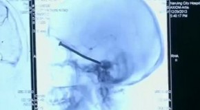 He Went in to the Hospital Because he Was Feeling Sick, What They Found in His Head Might Make YOU Sick