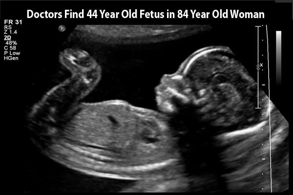 Doctors Find 44-Year-Old Fetus in Woman, 84