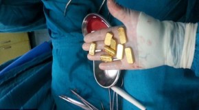 1lb of gold removed from businessman’s stomach by surgeons in Delhi