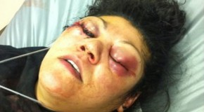 Woman’s Eyes “Blown to Pieces” by Cop With Gunpowder Powered Pepper Gun