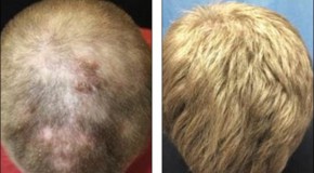Breakthrough as scientists successfully use arthritis drug to regrow a full head of hair on a man who suffered from severe alopecia