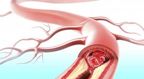 How stress can clog your arteries