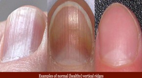 Eight Health WARNINGS Your Fingernails May Be Sending