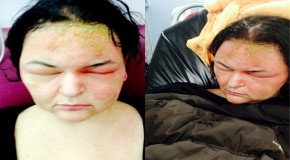 ‘I thought I was going going to die – because of my hair dye’: Woman is hospitalised after home-highlighting kit swells her head to size of rugby ball and leaves her unable to see for five days
