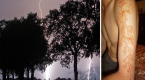 What it’s like to be struck by lightning (and survive)